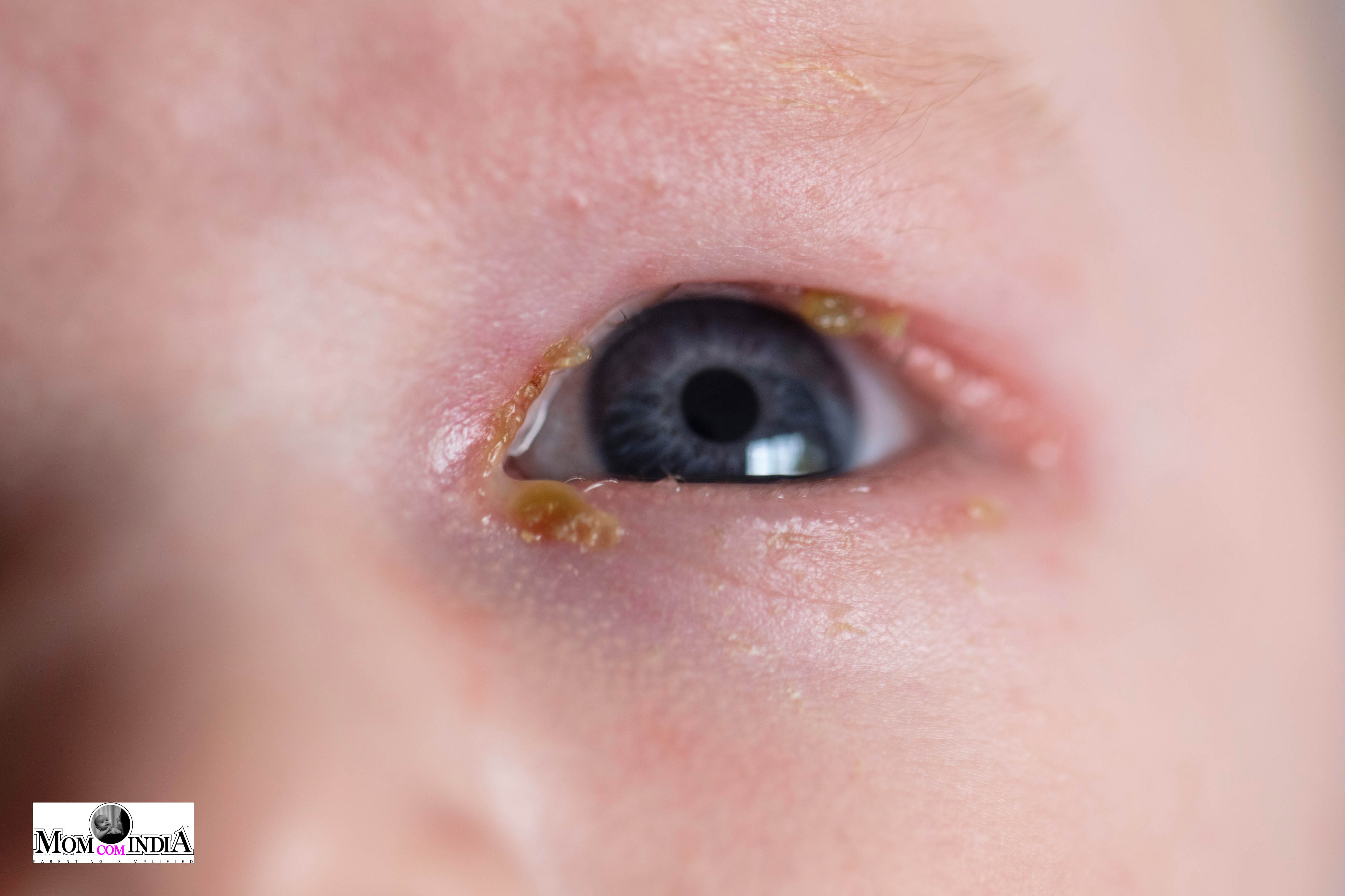 baby-watery-eyes-what-causes-infant-watery-eyes-women-s-alphabet